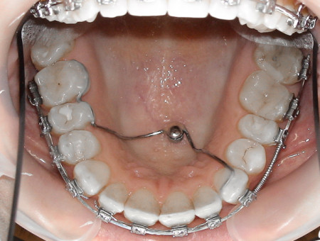Implanty ortodontyczne